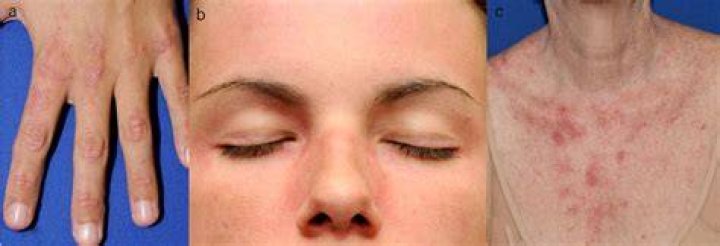 A Violaceous, Photodistributed Cutaneous Eruption and Leg Ulcer in a