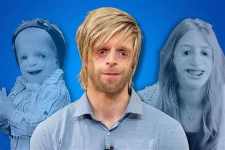 Author with Treacher Collins Syndrome Abandoned as a Baby, Now 'Full of