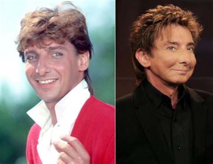 Barry Manilow before and after plastic surgery Celebrity plastic
