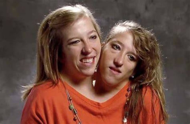 Conjoined Twins Abby and Brittany's Exciting News! Past Chronicles