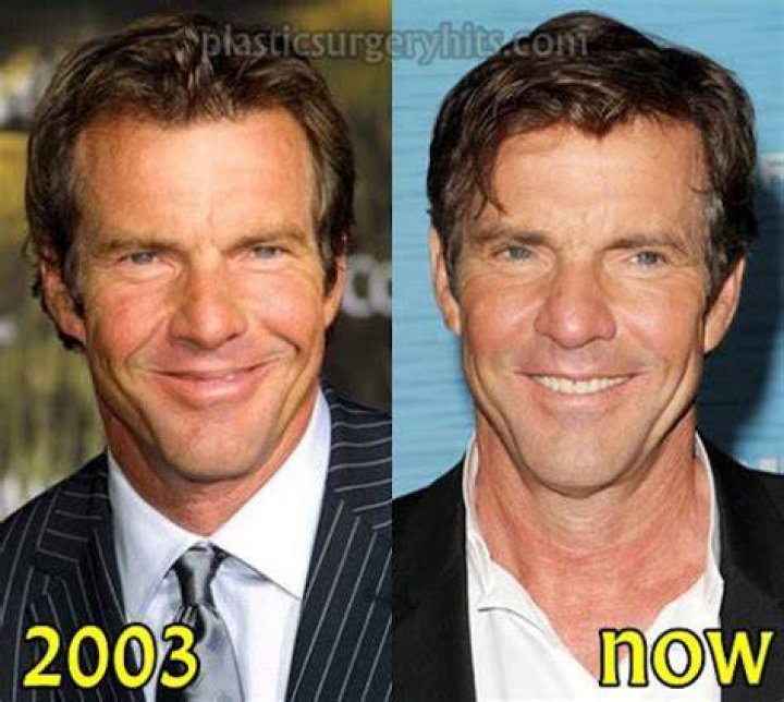 dennis quaid plastic surgery Archives Plastic Surgery Facts
