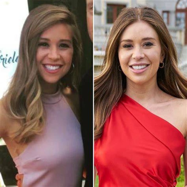 Gabby Windey Before And After Plastic Surgery: The Transformation Story