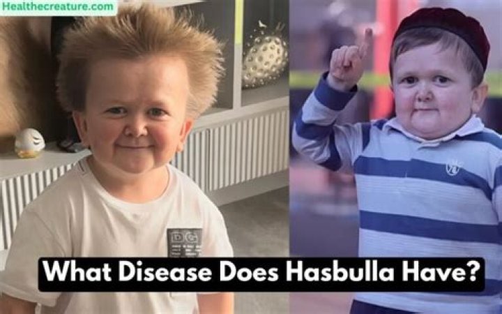 Hasbulla Disease And Illness What Treatment Is He Getting?
