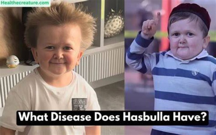 Hasbulla Illness What Disease Does Hasbulla Have?