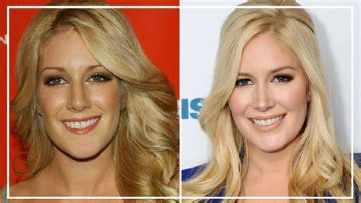 Heidi Montag's Plastic Surgery Transformation: Before And After The Knife