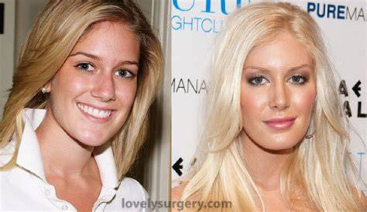 Heidi Montag Plastic Surgery: Before And After Transformation