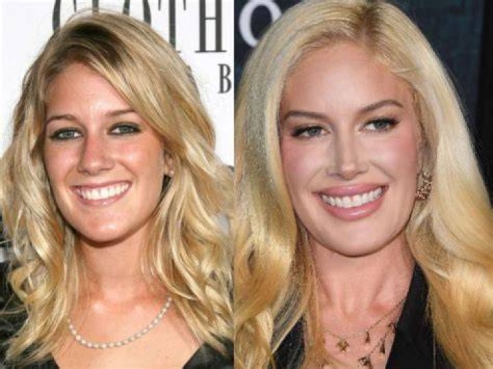 Heidi Transformation: Before And After Photos
