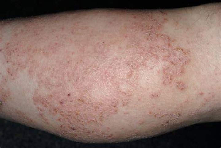 Increased Frequency of Eosinophilia Examined With Dupilumab in Patients