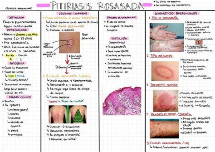 &iquest;Que es la Pitiriasis Rosada? (Causas, S&iacute;ntomas y Tratamiento)