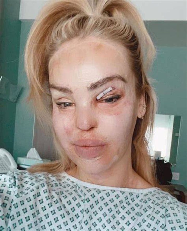 Katie Piper reveals bandaged eye in hospital as she recovers from