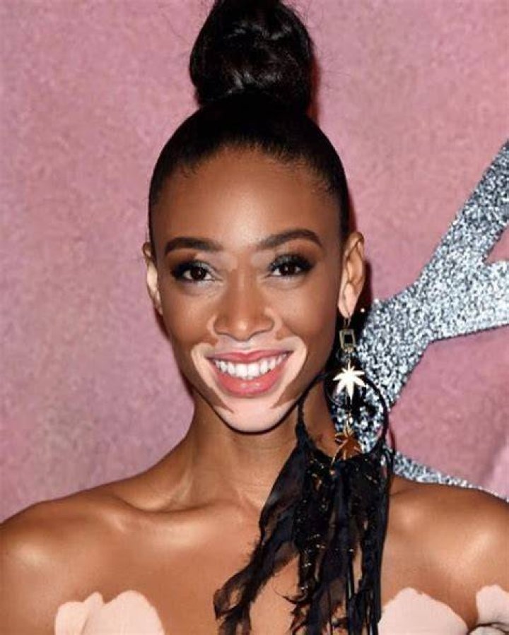 Meet Winnie Harlow, a Supermodel With Vitiligo, Who Has Been Fighting