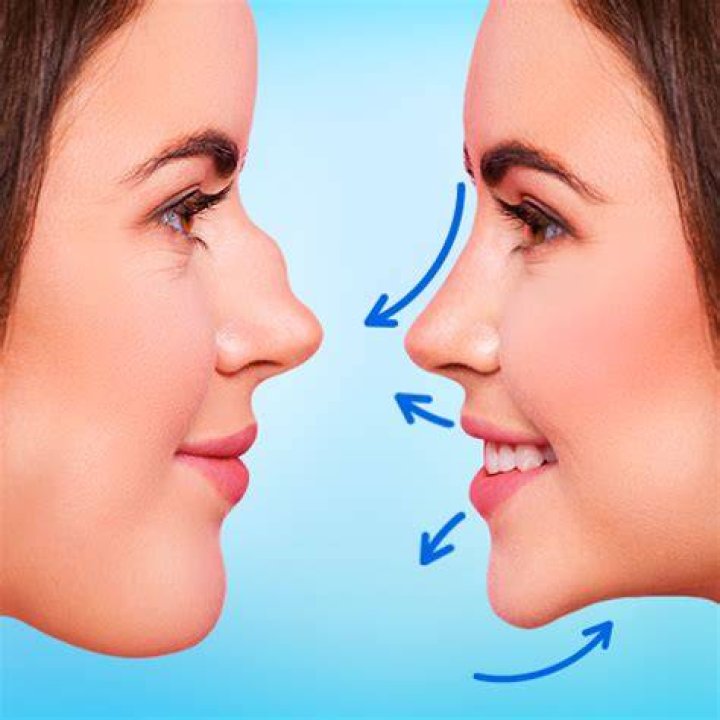 Nose Job App Online Nose Job Before And After Photos Are All Over