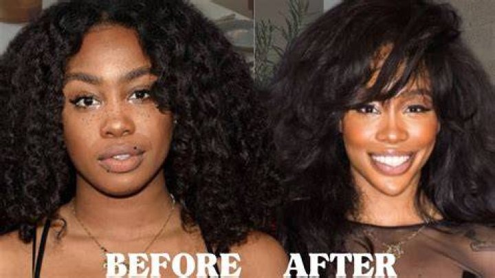 SZA Before Surgery and What She Looks Like After