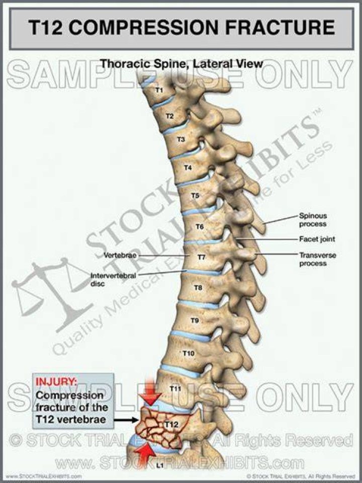 T12 compression fracture hires stock photography and images Alamy
