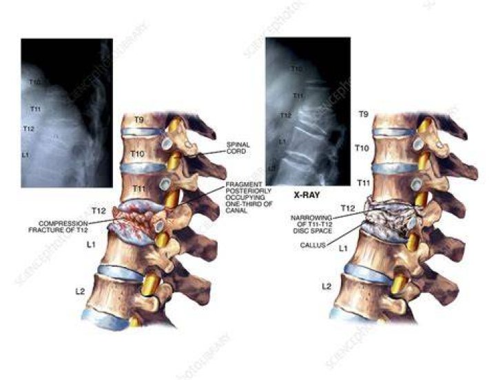 Thoracic Spine Compression Fractures Vertebra Plana