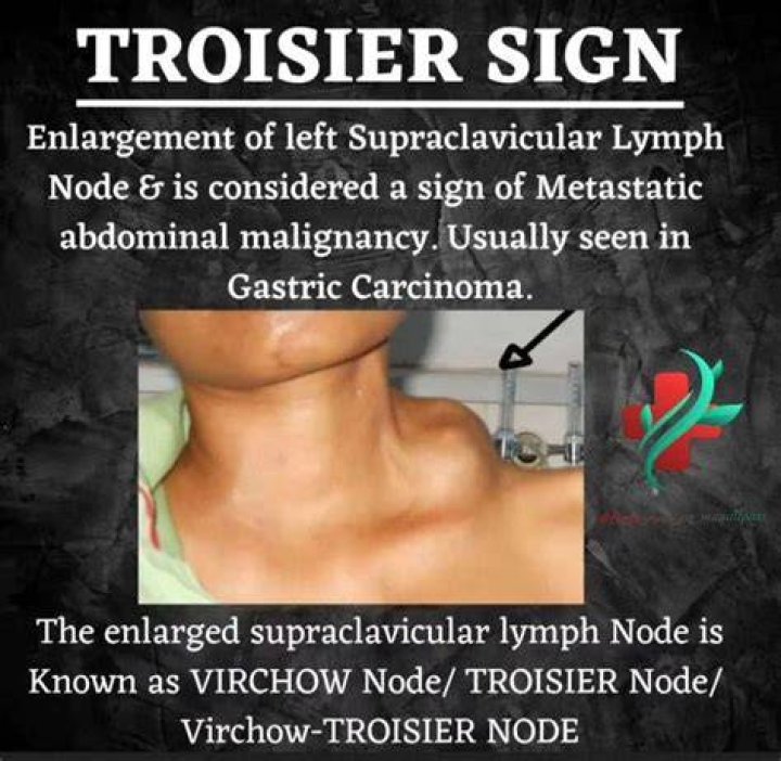 Troisier's sign Enlargement of the Virchow's lymph nodes MEDizzy