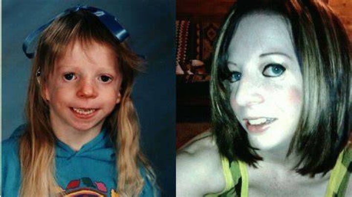 Woman With Treacher Collins Syndrome Fulfills Dream Of A Model